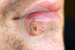 Cold sores (herpes labialis) photo