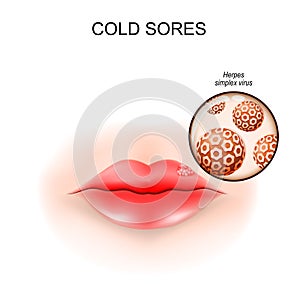 Cold sores in the lip. fever blisters