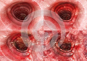 Colitis ulcerosa - all Stages- 3D rendering