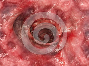 Colitis ulcerosa - Stage 4 - 3D rendering