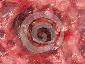 Colitis ulcerosa - Stage 4 - 3D rendering photo