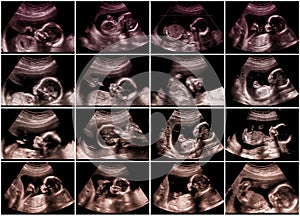 Collage of 16 ultrasonography fetus pictures