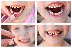 A collage of the child has lost the baby tooth. At 6 years old child loose tooth. The girl is holding the tooth in his hand.