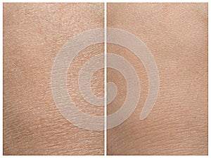 Collage demonstrating comparison of dry and moisturized human skin, closeup