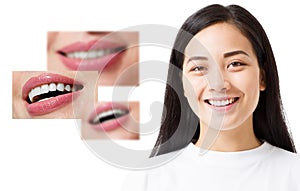 Collage of healthy smiling people. Beautiful asian young woman with white veneers and perfect smile. Tooth care dental medicine.