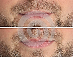 Collage with photos of man before and after lips augmentation, closeup