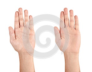 Collage with photos of man showing hands with dry and moisturized skin on white background, closeup