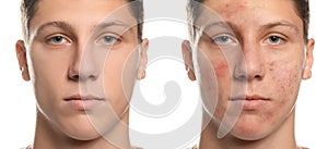 Collage with photos of teen guy with acne problem before and after treatment on white background. Banner design