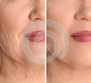 Collage with photos of woman having dry skin problem before and after moisturizing, closeup