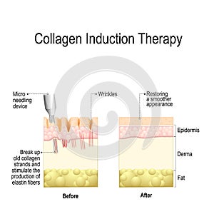 Collagen induction therapy microneedling