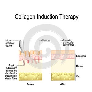 Collagen induction therapy microneedling photo