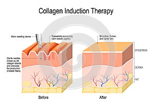 Collagen induction therapy. microneedling the skin