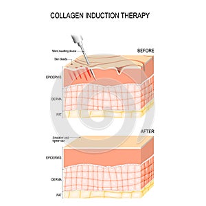 Collagen induction therapy. microneedling the skin