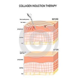 Collagen induction therapy. microneedling the skin photo