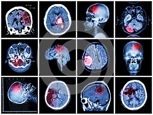 Collection of brain disease