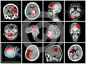 Collection of brain disease