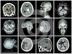 De cerebro enfermedad 