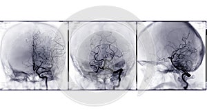 Collection of Cerebral angiography image.