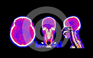 Collection colorful of CT angiography of the brain or CTA brain comparison Axial , Coronal and Sagittal view . Clipping path