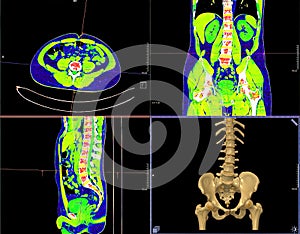 Collection of CT Lumbar spine or L-S spine 3D rendering .