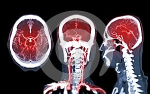 Collection of CTA brain or CT angiography of the brain  comparison Mip technique Axial ,Coronal and Sagittal view for detect brain