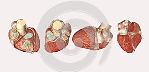 Collection of CTA Coronary artery  3D illustration.
