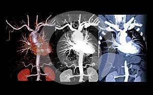 Collection of CTA thoracic aorta . photo