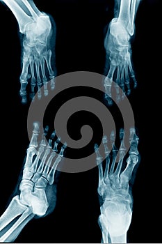 Collection foot x-ray