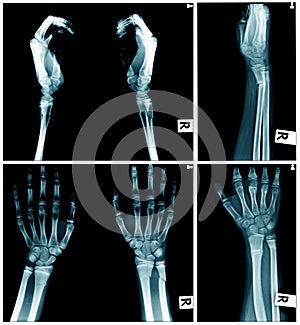 Collection hand and fore arm