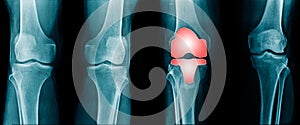 Collection knee x-ray
