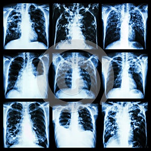 Collection of lung disease (Pulmonary tuberculosis,Pleural effusion,Bronchiectasis) photo