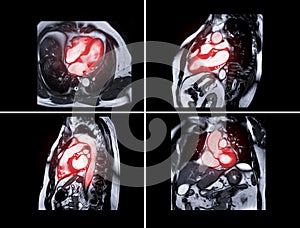 Collection of MRI heart or Cardiac MRI magnetic resonance imaging of heart  for diagnosis heart disease