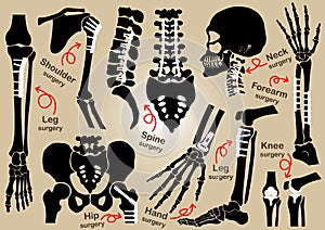 Collection of Orthopedic surgery ( Internal fixation by plate and )( skull , head , neck , spine , sacrum , arm , forearm , photo
