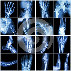 Collection X-ray multiple bone fracture