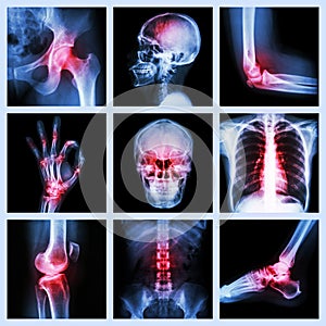 Collection X-ray and multiple injury