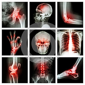 Collection X-ray and multiple injury