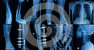 Collection of X-ray , Multiple part of adult show fracture bon