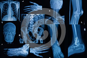 Collection of X-ray , Multiple part of adult show fracture bon