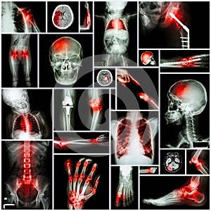 Collection of X-ray multiple part of human,Orthopedic operation and multiple disease (Shoulder