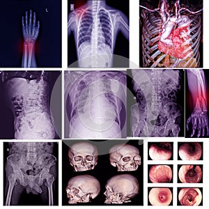 Collection X-ray multiple part of human & Orthopedic surgery & Multiple disease Osteoarthritis knee,spondylosis,Stroke,Fracture