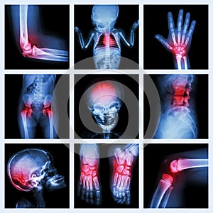 Collection X-ray part of child and multiple injury