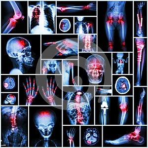 Collection X-ray part of human,Orthopedic operation,Multiple disease (Fracture,Gout,Rheumatoid arthritisOsteoarthritis