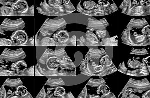 Collection of ultrasonography fetus scans