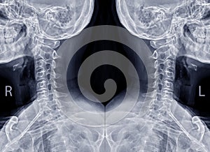 Collection of X-ray C-spine or x-ray image of Cervical spine oblique view