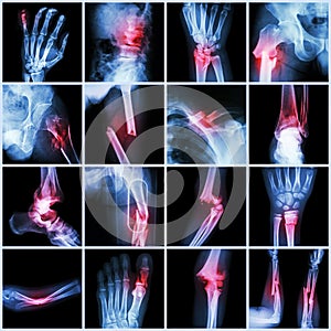 Collection X-ray multiple bone fracture photo