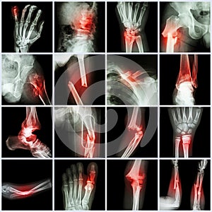 Collection X-ray multiple bone fracture photo