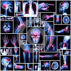 Collection X-ray multiple organ and arthritis at multiple joint ( Rheumatoid, Gout) photo