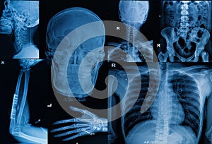 Collection of X-ray , Multiple part of adult show fracture bon