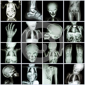 Collection X-ray part of child body