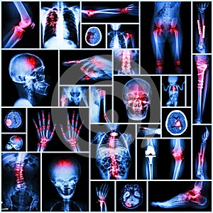 Collection X-ray part of human,Orthopedic operation,Multiple disease